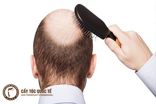 Rụng tóc nhiều ở phần đỉnh đầu dẫn đến hói đỉnh đầu ở nam giới Rụng tóc nhiều ở phần đỉnh đầu dẫn đến hói đỉnh đầu ở nam giới