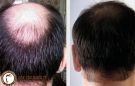 Chữa hói đỉnh đầu nam – không khó như bạn nghĩ?