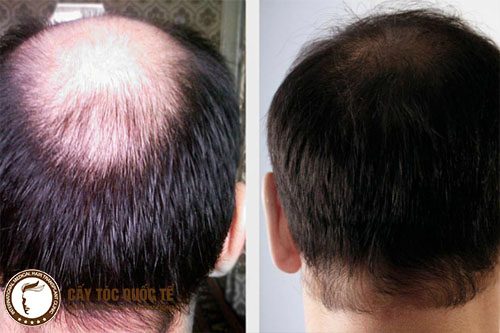 Hình ảnh trước và sau khi thực hiện cấy tóc tự thân hói đỉnh đầu Hình ảnh trước và sau khi thực hiện cấy tóc tự thân hói đỉnh đầu