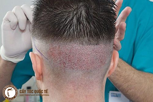 Hình ảnh lấy nang tóc chắc khỏe ở phần sau để cấy lên phần bị hói trị hói trán cho nam giới Hình ảnh lấy nang tóc chắc khỏe ở phần sau để cấy lên phần bị hói trị hói trán cho nam giới