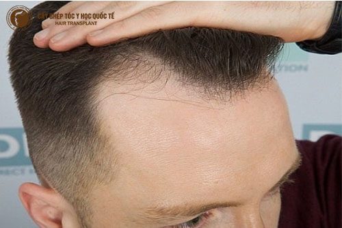 Hình ảnh hói trán chữ M 