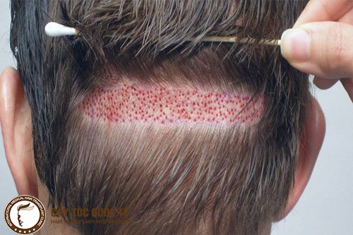 Cấy tóc tự thân lấy tóc chắc khỏe từ sau phần gáy 