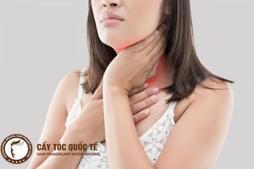 Mắc bệnh về tuyến giáp bị hói đầu khi còn trẻ Mắc bệnh về tuyến giáp bị hói đầu khi còn trẻ