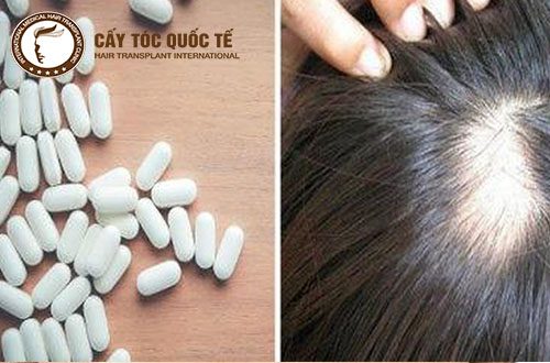 Dùng thuốc để kích thích tóc mọc 