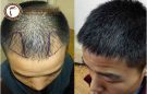 Hói đầu khi còn trẻ và phương hướng điều trị