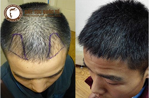 Cấy tóc tự thân phương pháp trị hói đầu khi còn trẻ hiệu quả nhất Cấy tóc tự thân phương pháp trị hói đầu khi còn trẻ hiệu quả nhất