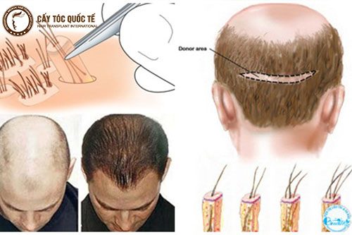 Hình ảnh minh họa cấy tóc tự thân Hình ảnh minh họa cấy tóc tự thân