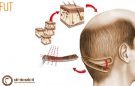 Cấy tóc tự thân có hiệu quả không?