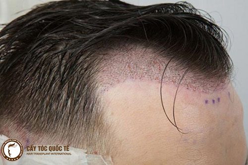 Hình ảnh cấy tóc sinh học bị sừng hóa viêm da đầu Hình ảnh cấy tóc sinh học bị sừng hóa viêm da đầu