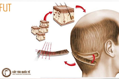 hình ảnh quy trình lấy nang tóc để cấy trong phương pháp cấy tóc Fut hình ảnh quy trình lấy nang tóc để cấy trong phương pháp cấy tóc Fut