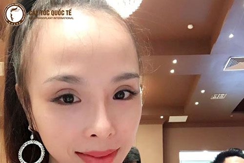 Hình ảnh trán cao bẩm sinh khiến gương mặt mất đi sự hài hòa Hình ảnh trán cao bẩm sinh khiến gương mặt mất đi sự hài hòa