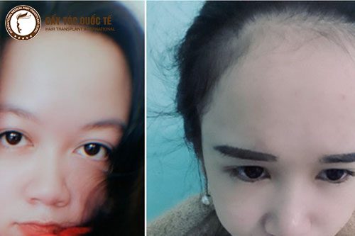 Tỷ lệ giữa trán và khuôn mặt không cân bằng với nhau gây mất hài hòa tổng thể Tỷ lệ giữa trán và khuôn mặt không cân bằng với nhau gây mất hài hòa tổng thể