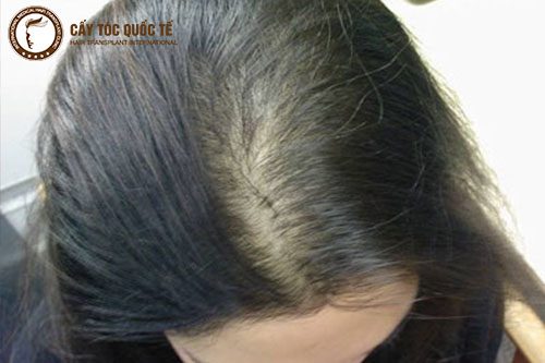 Stress căng thẳng quá cũng gây ra hói đầu ở nữ Stress căng thẳng quá cũng gây ra hói đầu ở nữ