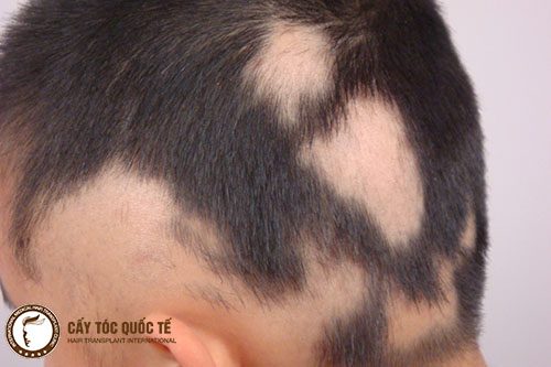 Hình ảnh hói đầu kiểu Areata Hình ảnh hói đầu kiểu Areata
