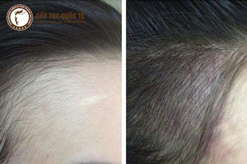Suy giảm chức năng của tuyến giáp dẫn đến rụng tóc và hói đầu ở cả nam và nữ Suy giảm chức năng của tuyến giáp dẫn đến rụng tóc và hói đầu ở cả nam và nữ