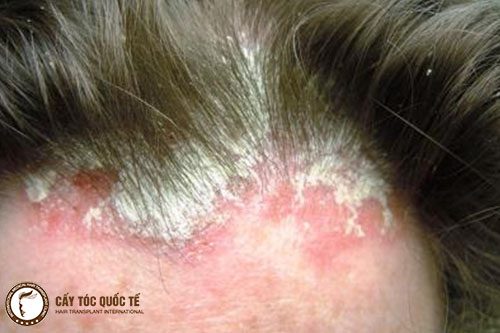 Đội tóc giả có khả năng bị ngứa, viên nhiễm da đầu Đội tóc giả có khả năng bị ngứa, viên nhiễm da đầu