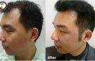 Cấy tóc mai – giúp bạn hồi xuân và tự tin với vẻ ngoài hoàn mỹ