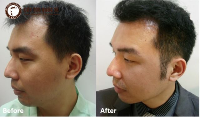 Cấy tóc mai – giúp bạn hồi xuân và tự tin với vẻ ngoài hoàn mỹ