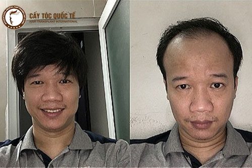 Tóc giả lấy lại sự tự tin cho người hói rất nhiều Tóc giả lấy lại sự tự tin cho người hói rất nhiều