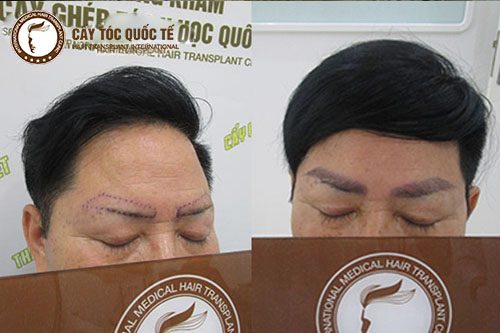 Hình cấy lông mày tự thân trước và sau 3 tháng Hình cấy lông mày tự thân trước và sau 3 tháng