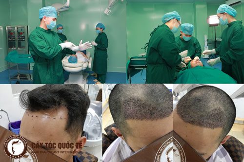 Tóc chữ M là gì và cách điều trị hiệu quả nhất?