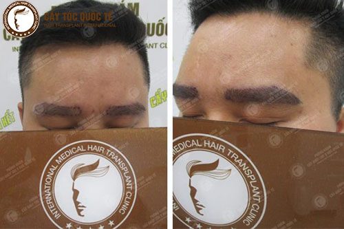 Hình Ảnh Trước ( trái ) - Sau ( phải ) khi cấy lông mày Tại PK Cấy Tóc Quốc Tế 260 Nguyễn Đình Chiểu Hình Ảnh Trước ( trái ) - Sau ( phải ) khi cấy lông mày Tại PK Cấy Tóc Quốc Tế 260 Nguyễn Đình Chiểu