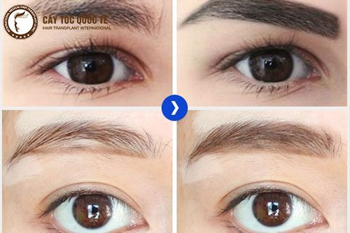 Mách bạn cách xóa sẹo lông mày cực kỳ hiệu quả