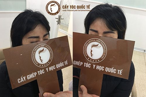 Ưu điểm vượt trội khi thực hiện cấy lông mày cho nữ