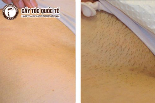 Hình ảnh Trước ( Trái ) - Sau ( Phải ) Cấy Lông Mu Được 2 Tháng Hình ảnh Trước ( Trái ) - Sau ( Phải ) Cấy Lông Mu Được 2 Tháng