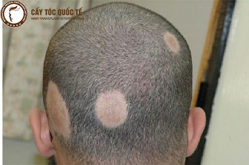 4 điều không thể bỏ qua khi bị rụng tóc hình đồng xu