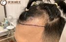 Chữa rụng tóc 2 bên trán như nào mới hiệu quả?