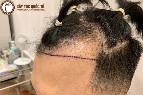 Chữa rụng tóc 2 bên trán như nào mới hiệu quả?