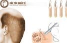Cấy tóc sinh học giữ được bao lâu? Hiệu quả có ổn định không?